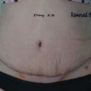 Day 12. I removed the drains. Still swollen