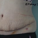Still swollen day 12. Wrinkles are from the binder