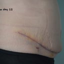 Day 12 Swollen