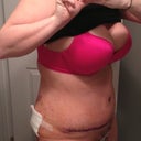 Day 6 post op