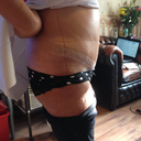 2 weeks post op