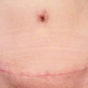 Front Scar..BB scar is fading quicker..hopefully I'll get the same results with the others.