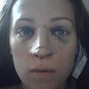 Day of Surgery. Sorry for the blood, but I was changing the drip pad. But here you can really see how much distance there is from my upper lip and nose. I'm so happy that my nose doesn't look upturned at all! You can also see how much smaller the tip is!