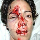Female Biking Accident