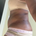 4 months PO left side