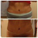 Top photo 6 months post op, night before revision... Bottom: morning after revision