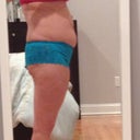 Night before surgery side view