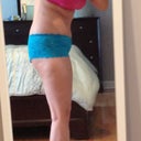 2 week post op side leaning over
