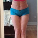 2 week post op front leaning over