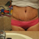 PO day 14 scar is low but not low enough for the new Vic Secret bikini I just bought..Oh well...