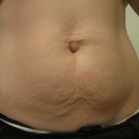 before, better look at hernia and how bulgy/poochy my belly was