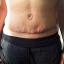 3 weeks post op