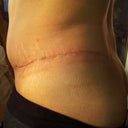 3 weeks post op