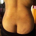 3 weeks post op