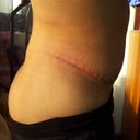 1 month Post Op Extended TT