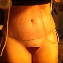 9 Days PO   Front View.  Drains still in, but no pain at all.