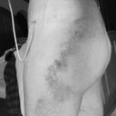 9 days PO   Bruising is pretty bad.