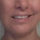 After botox injection