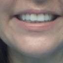 3 months and 5 days later, smile is getting better!!