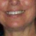Before botox injection