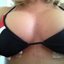 Taken 4 days post op