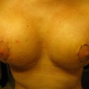 3 weeks post-op , looking better, starting to see a shape that I'm liking :) oh yeah and you can see the small pimple I'm taking about on my right one.