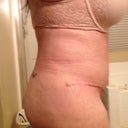Right Side Swollen.  End of the day 4wk 5days
