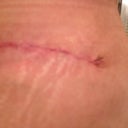 Left Scar 4wk 5days