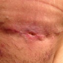 Hole I thought was spitting a stitch.  PS said it is not and it is fine.  Told me to put more Bacitracin on it several times a day. 4wk 5days