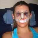 Immediately after rhinoplasty surgery