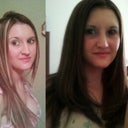 Rhinoplasty before/after