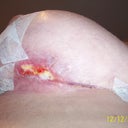 Post op week 5. The T section under the left one isn't healing as well as the right side.