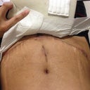4 weeks : Belly button finally scabbing up, Swelling down ALOT but still numb and hard  on lower part of belly, which is normal. Veriticle insition scab is slowly falling off, i hope that it lightens up and  ends up looking like a stretch mark once its  healed because it sure looks  ugly :(