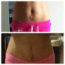 The bottom pic is a bit old at 2 weeks post op - Just to compare how I looked before and after -  i notice Major changes around muffin top which I'm super happy about :) can't wait to see final results
