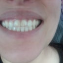 before whitening