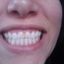 after whitening