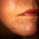 Acne Scarring And Melasma