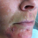 Acne Scarring And Melasma