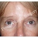 Forehead Lift