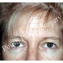 Forehead Lift