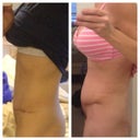 RIGHT: 5 weeks post op during the swelling from hell period (this is how I looked for a full 8 weeks) , LEFT: 12 weeks post op