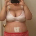 1 Day post op