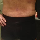 2 weeks post op