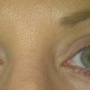 Prior to Ulthera & (generic) Latisse