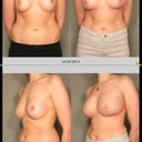 Left before, right 7 weeks po