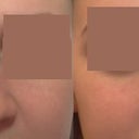 My nose | Doctor's image of what my nose might look like