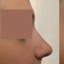 My nose | Doctor's image | My edited image to show what I'd prefer