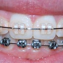 January 13th - Conventional braces to correct botched Six Month Smiles orthodontics.