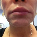 No bruising on lip or cheeks