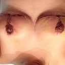 9 days post op